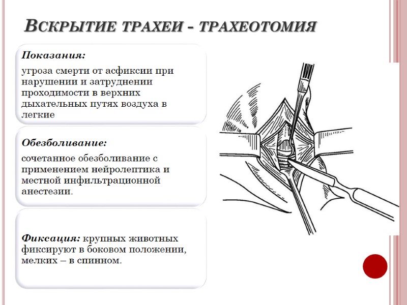 Вскрытие трахеи - трахеотомия